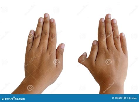 isolation photo  polydactyly  human rare abnormal characteristic