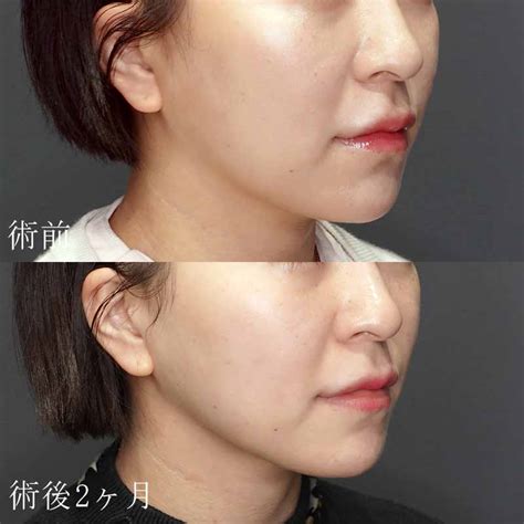 医療用HIFU（ハイフ）ウルトラフォーマーMPTの症例写真・ビフォーアフター | 美容皮膚科なら水の森美容クリニック