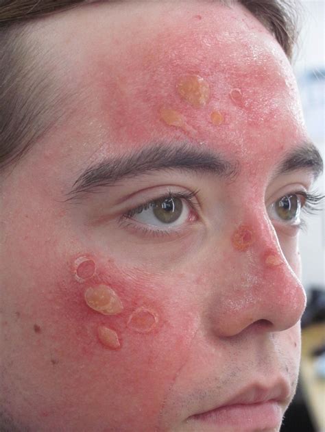 Swollen Eyes Sunburn Treatment at Paul Caison blog