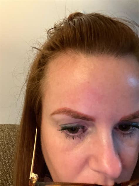 Terrified…..I just had a laser removal treatment done today and I am