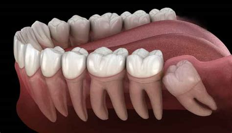 Third-Molar Extraction May Improve Taste Ability - Dimensions of Dental Hygiene