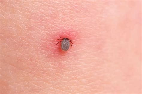 Poisonous Ticks Bites