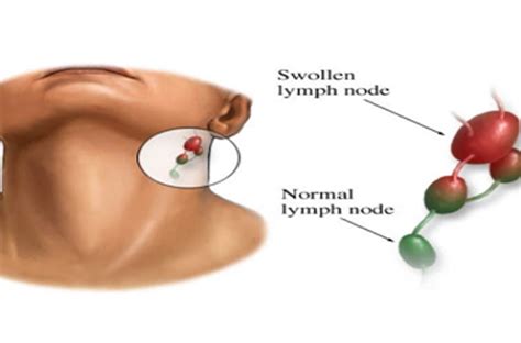 Lymph Node Cancer