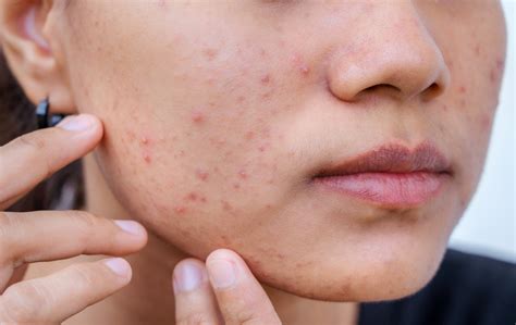 kids health info acne  teen skin health