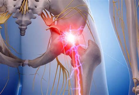 sciatica  symptoms treatment medications prevention