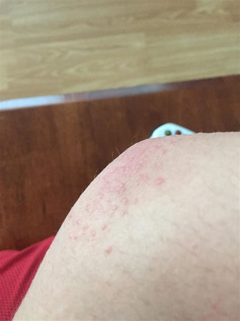 Anybody know what these bumps are on my elbow? : r/popping