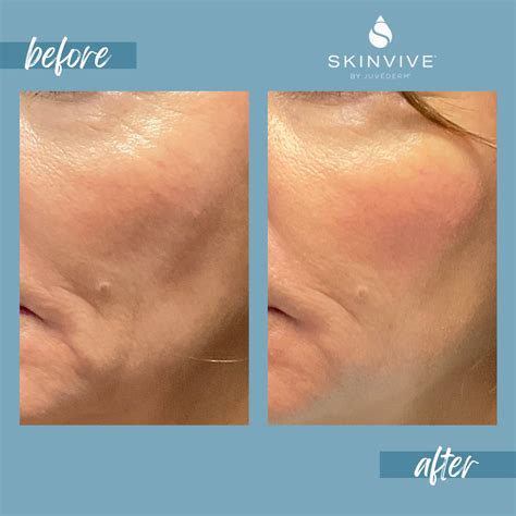 Skinvive Antes E Depois - Skinvive Before & Afters | Rejuvenate Colorado