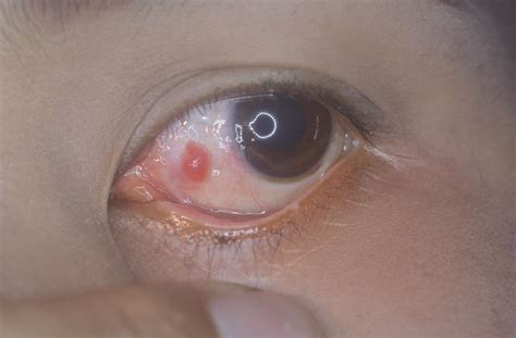 pyogenic granuloma