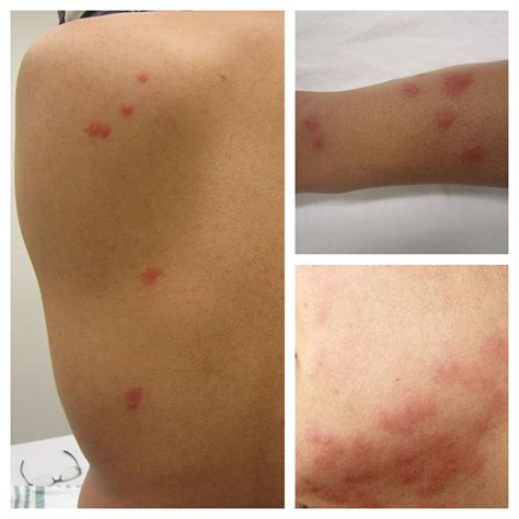 bed bug bites  flea bites sterifab bed bug blog