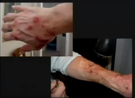 morgellons disease photo - pictures, photos