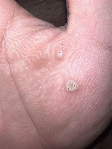Is this just a wart? : r/medical_advice