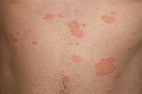 Розов лишей (Pityriasis rosea) | todeva.com