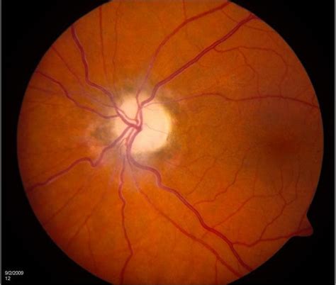 Optic Nerve Disease - Eye Specialist, Treatments, Types and Symptoms