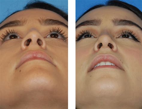 How To Make A Fat Nose Smaller Without Surgery - My Bios