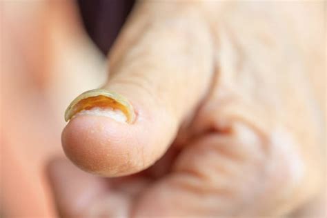 170+ Psoriasis In Toenails Stock Photos, Pictures & Royalty-Free Images - iStock