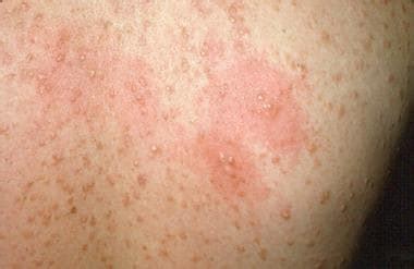 Hemochromatosis Skin Rash