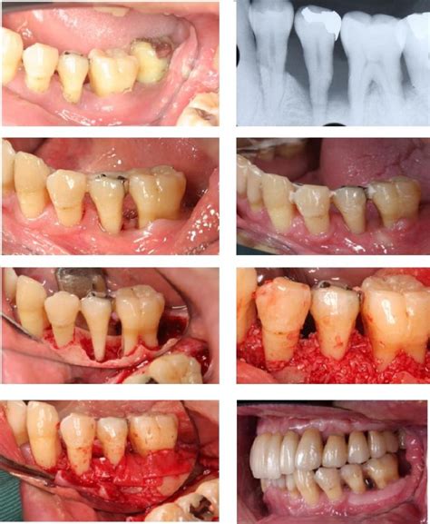 Dental bone graft healing stages