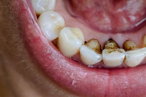 how to get rid of tobacco stains on teeth