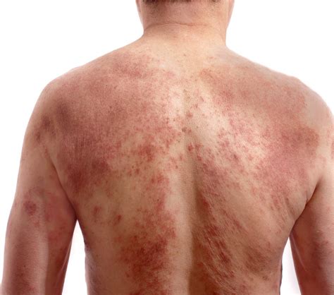 Eliminating Eczema Naturally - Your Body Has The Answer