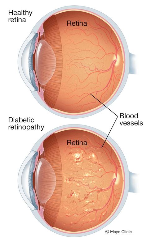 Diabetic retinopathy - Symptoms & causes - Mayo Clinic