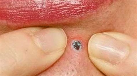 Unbelievable Blackhead Removal 2024: A Comprehensive Overview - od3oujy
