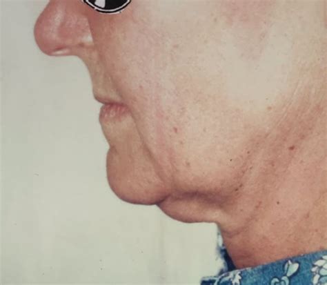 Facelift (Rhytidectomy) - Dr Hamilton