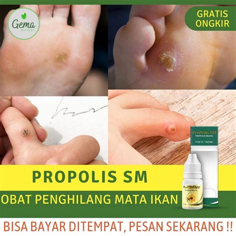 obat oles penghilang mata ikan obat infeksi mata ikan obat gatal