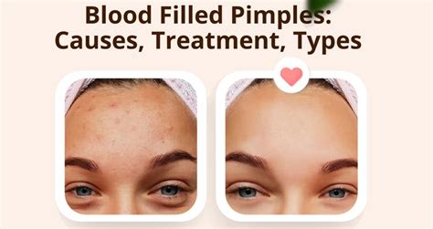 Blood Filled Pimples: Causes, Treatment, and Types