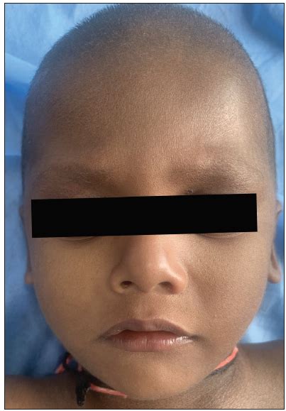 unveiling   gene mutation  neonatal ichthyosis sclerosing