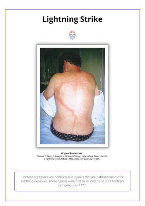 Lightning Strike Injuries