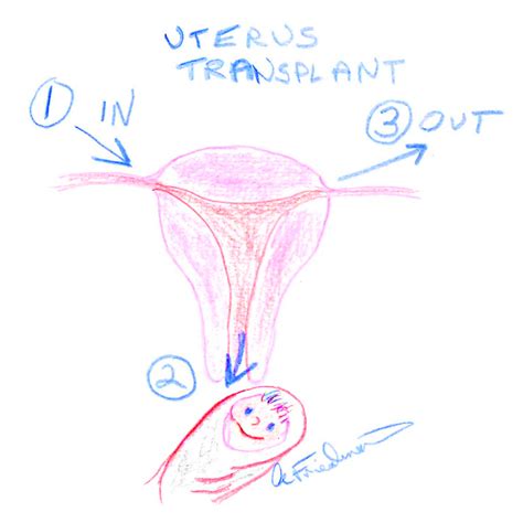 What's Hot / What's New: WHY TRANSPLANT A UTERUS?