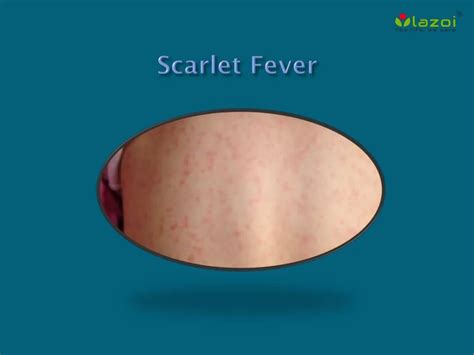 PPT - Scarlet Fever: Causes, Symptoms, Treatment and Prevention ...