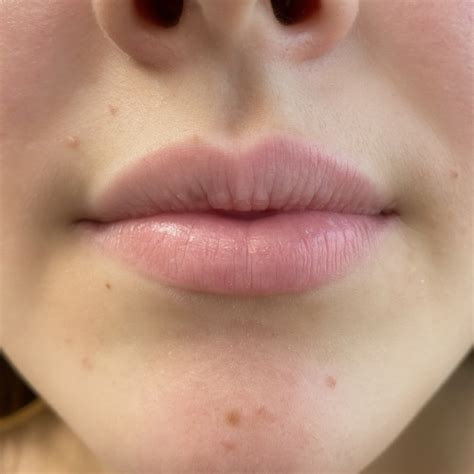 Natural Lip Enhancement - La Clinique Aesthetics