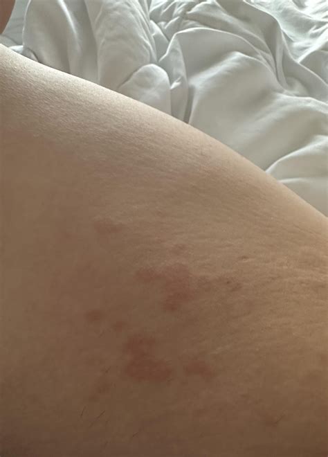 Rashes on both inner thighs : r/Dermatology