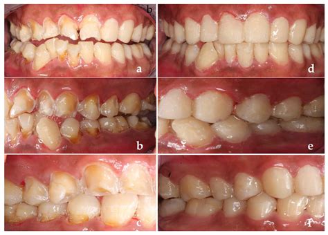 Application of a Caries Treatment Difficulty Assessment System in