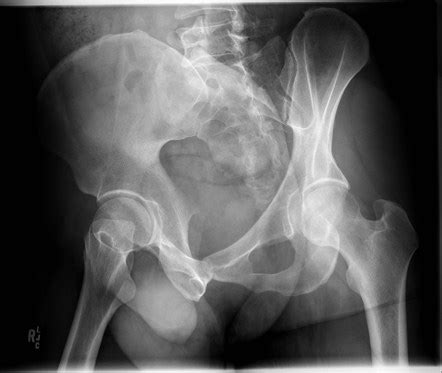 pelvis judet view radiology reference article radiopaediaorg