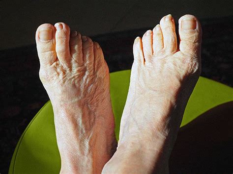 osteoarthritis   big toe symptoms