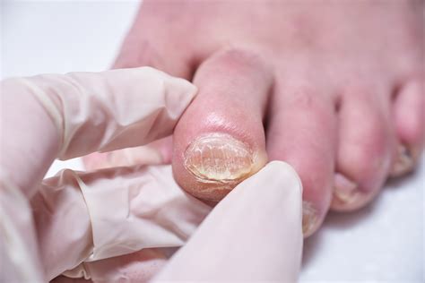 Embarrassing nail fungus got you down? Get Caratin Rx for immediate