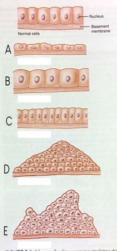 Pathophysiology - Ch. 3: Cell Adaptation, Injury and Death Flashcards ...