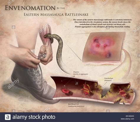 Medical illustration depicting the effects of envenomation by the eastern massasauga rattlesnake ...