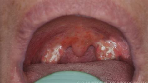 how to get rid of strep throat fast - YouTube