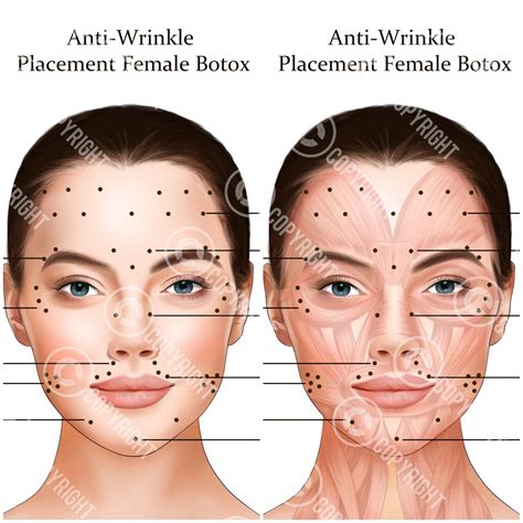 Botox Injection Points Bundle | Botox & Filler Injector | Anatomy | Art
