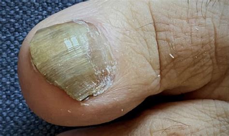 Diabetes Help 4 Friends: Diabetes symptoms: Why toenails falling off ...