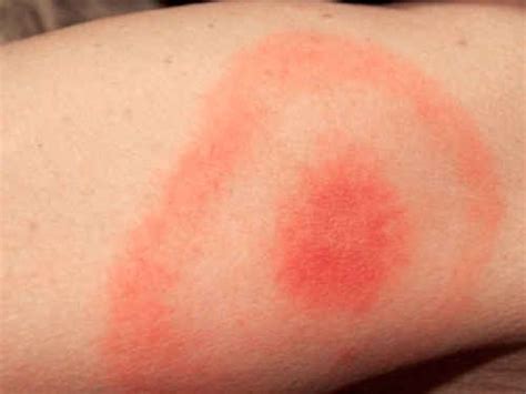 how to know if i have ticks
