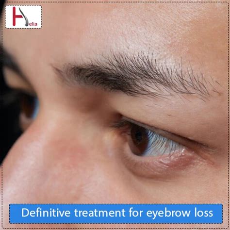 Eyebrow Hair Loss: 13 Reasons for Thin Eyebrows with Medical and Home ...