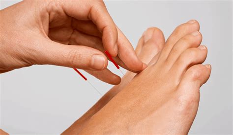Acupuncture for Tendonitis | ACA Acupuncture and Wellness