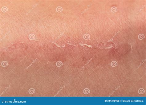 Rascar La Piel De La Pierna Como Fondo Foto de archivo - Imagen de ...