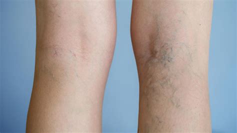 Symptoms and Treatments For Reticular Vein in Melbourne