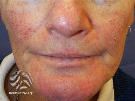 Rosacea papules pustules 3610 DNZ - theGoodSkinPlace