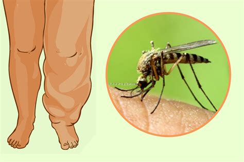 clinical manifestation  lymphatic filariasis  health quest